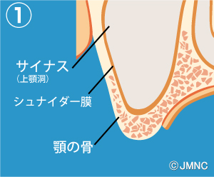 サイナスリフト