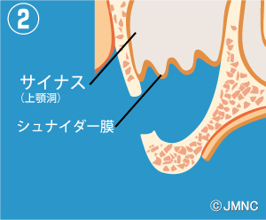 サイナスリフト